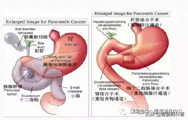 三个月孕妇肚子大小图，探索孕早期腹部变化的奥秘